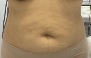 before skin tightening treatment