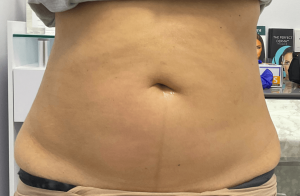 skin tightening treatment