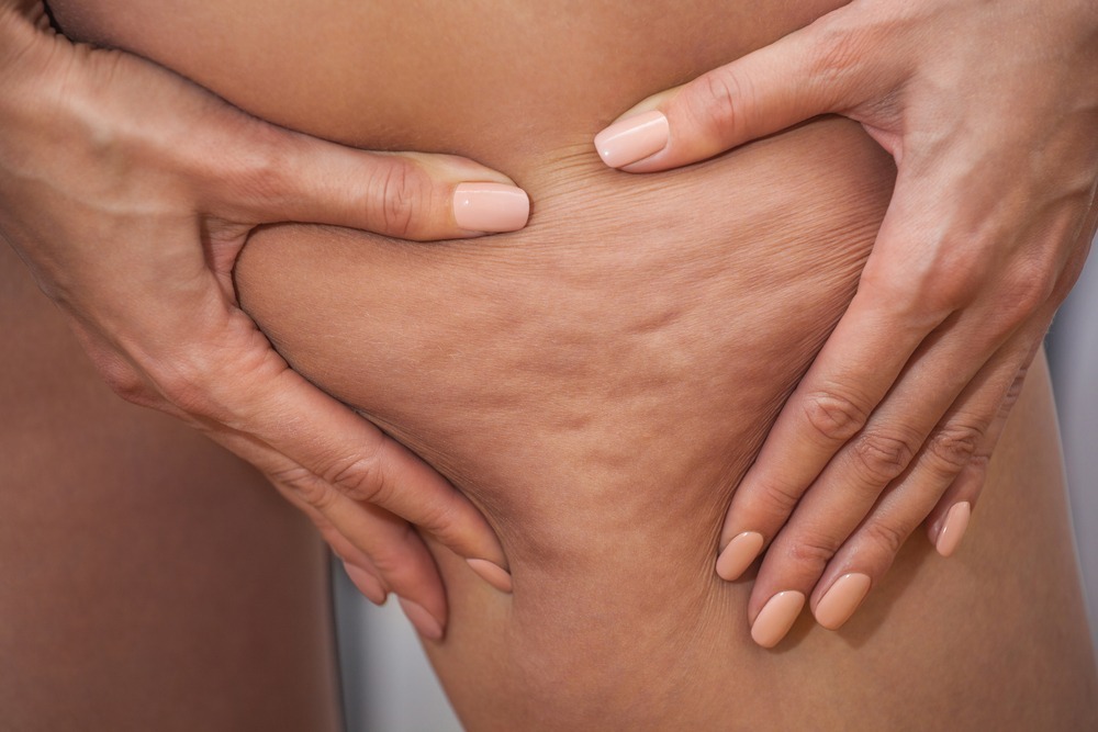 Recommendations From the Best Cellulite Doctor in Tysons Corner