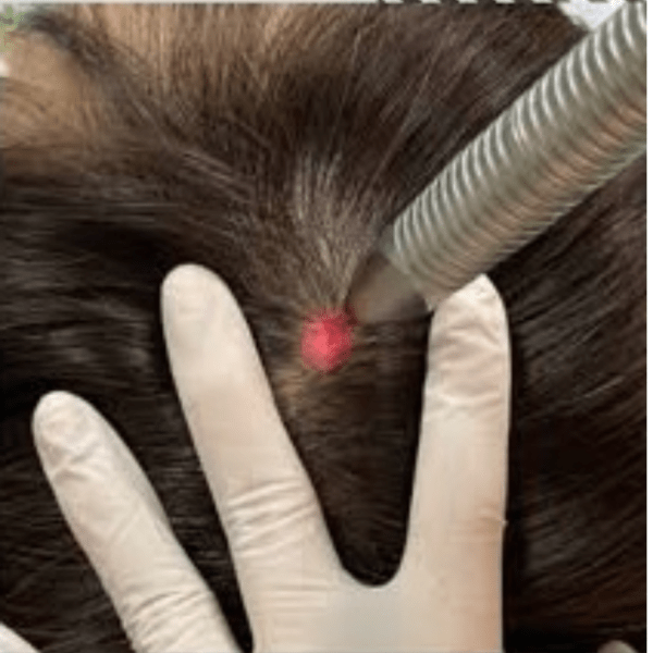 Best treatment for hair loss in DMV