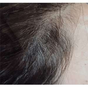 Best treatment for hair loss after photo
