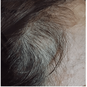 Best Treatment for female pattern hair loss