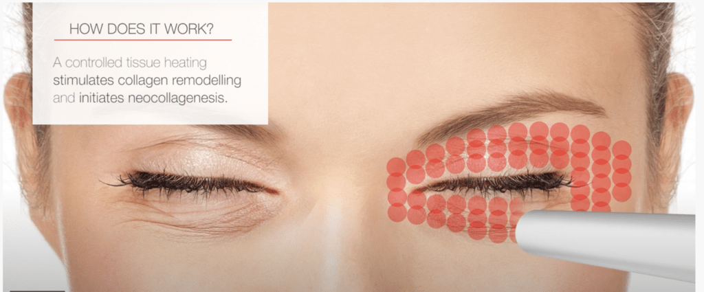 Fotona Smootheye treatment laser eye lid lift