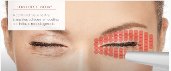 Fotona Smootheye treatment laser eye lid lift