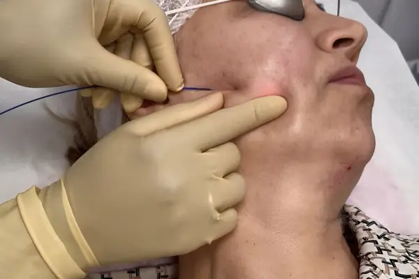 Endolift vs Endotight