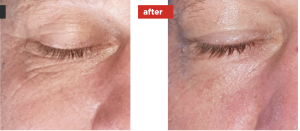 Laser Eyelid Lift Before & After