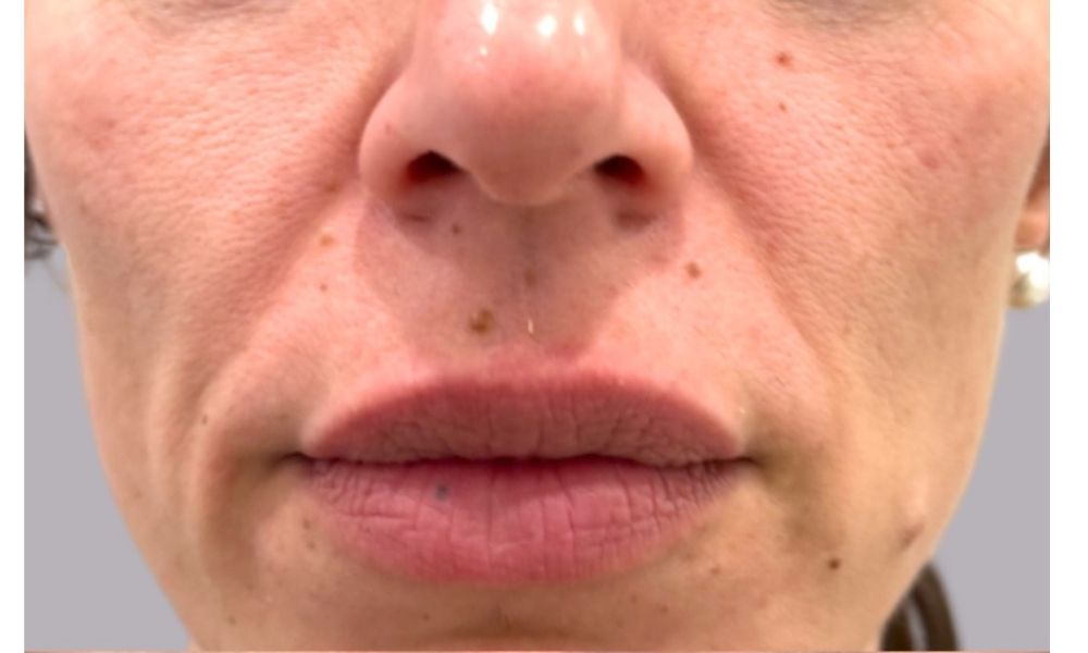 Laser face Lift in McLean VA Before and after