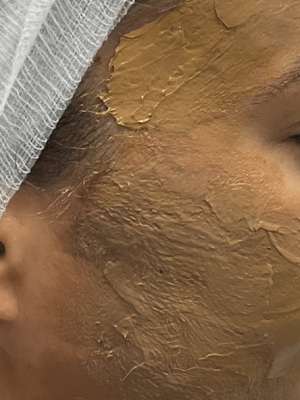 Cosmelan Peel Applied