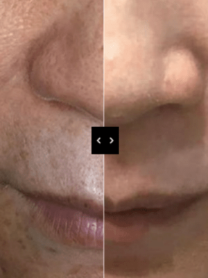 cosmelan peel