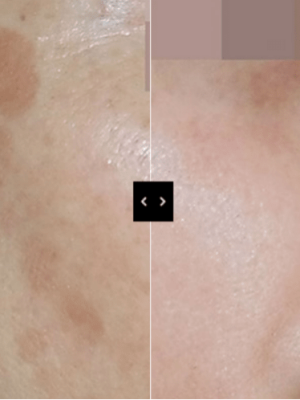 cosmelan peel results